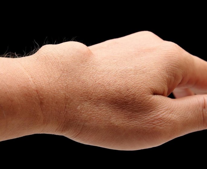 Boules : 3 symptomes anormaux