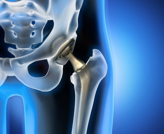 Protheses de hanche suspendues : qui doit voir rapidement son chirurgien ? 