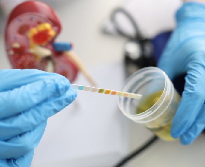 Les americains mettent au point un test urinaire capable de deceler 94 % des cancers de la prostate agressifs