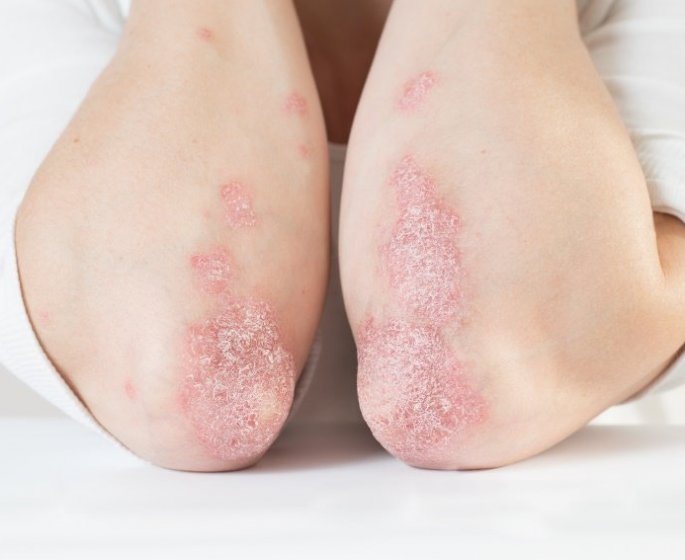 Psoriasis : “Depuis le traitement j’ai enfin la vie dont j’avais reve !”
