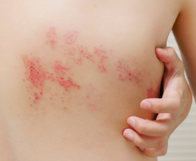 Urticaire au froid : 7 signes qui peuvent alerter