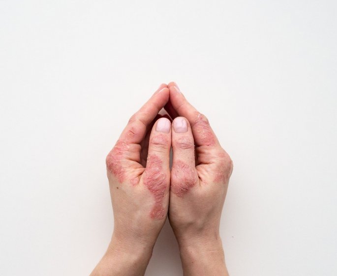 Le psoriasis en 5 questions