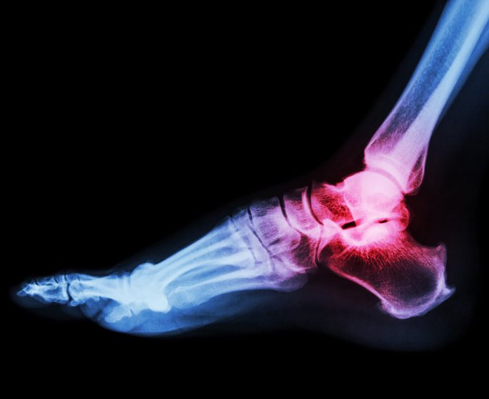 Arthrose du pied : les exercices faciles a faire au quotidien