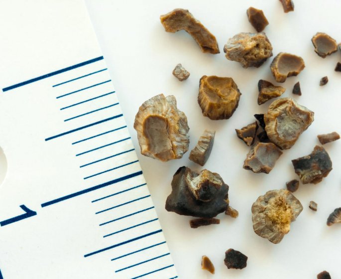 Calcul renal : de quoi est-il constitue ?