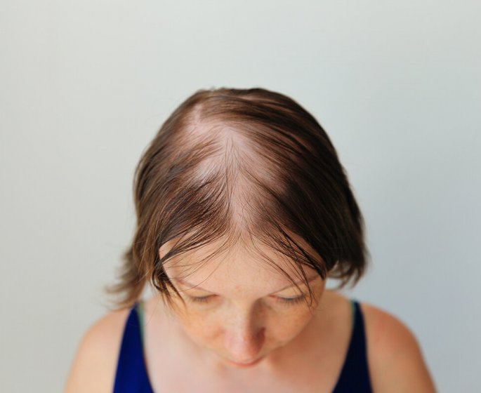 Covid-19 : il pourrait etre a l’origine de l’alopecie