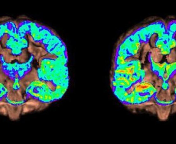 Sur une de ces photos, un cerveau est atteint de la maladie d’Alzheimer