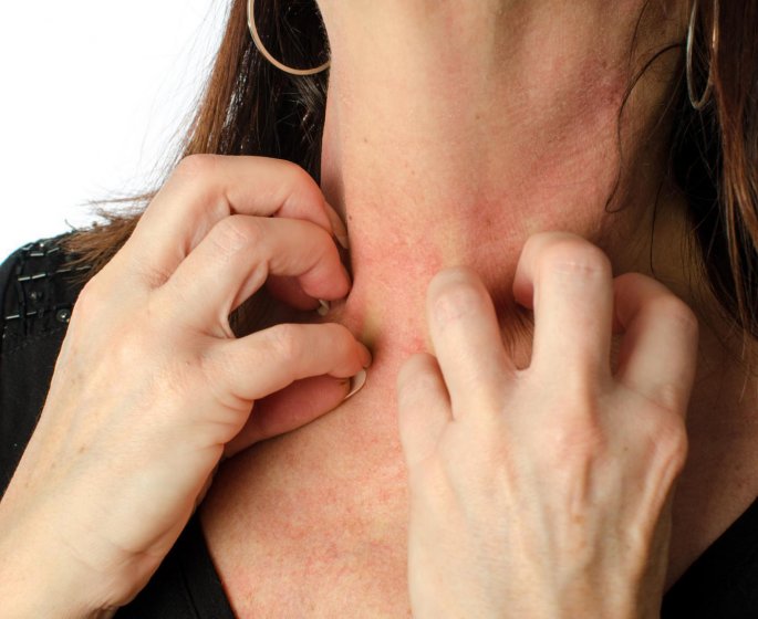 Psoriasis inverse : qu-est-ce que c-est ?