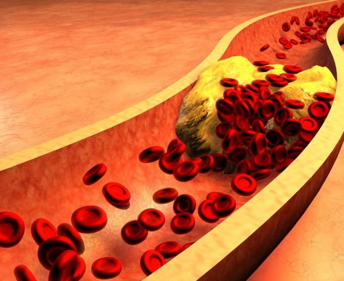 Atherosclerose : 50% des 40-54 ans ont cette maladie sans le savoir
