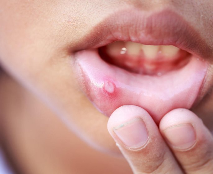 Aphte langue, bouche, gencive, levre… : symptomes, causes et traitements