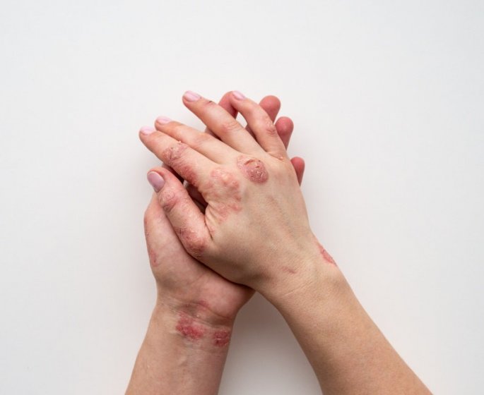 Temoignage : comment mieux vivre au quotidien avec un psoriasis ?
