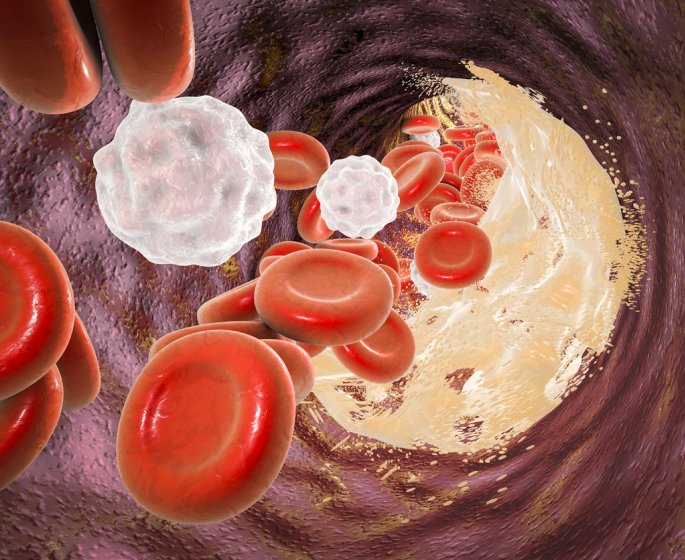 Exces de graisse dans le sang : les taux critiques de cholesterol et de triglycerides