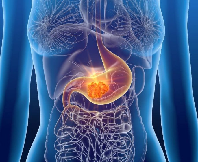 Cancer de l’estomac : le celibat augmente les risques de deces