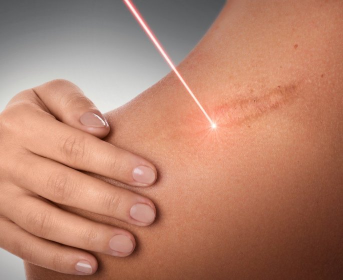 Nos astuces pour camoufler ses cicatrices