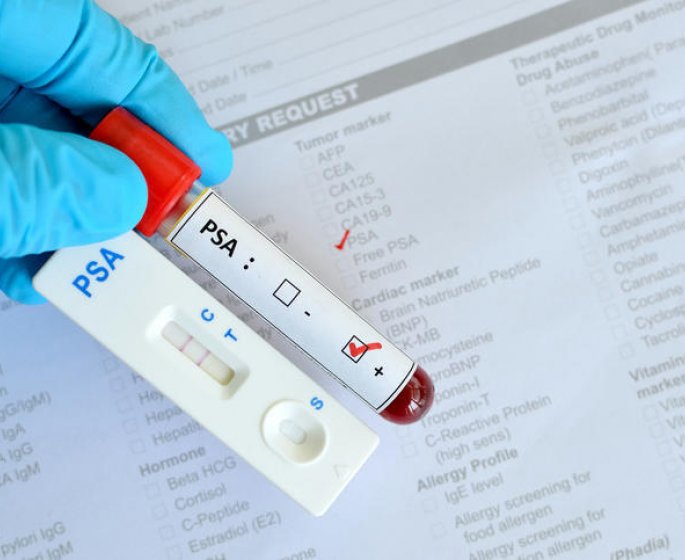 PSA eleve : un signe d-adenome de la prostate ?