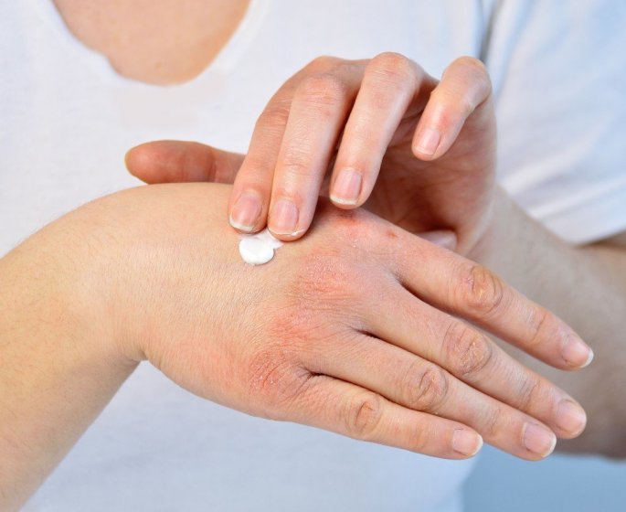 Froid : 4 astuces pour eviter les gercures