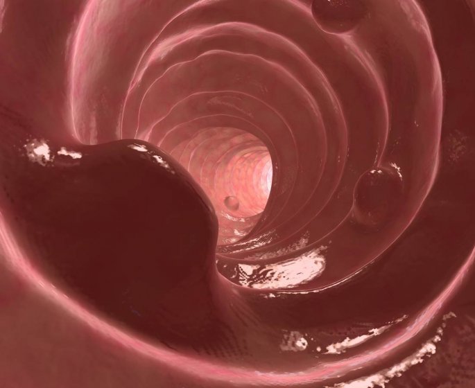 Polypes du colon et rectum (intestinaux) : symptomes, traitements, biopsie