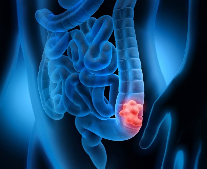 Polypes : 8 choses vraies a savoir absolument