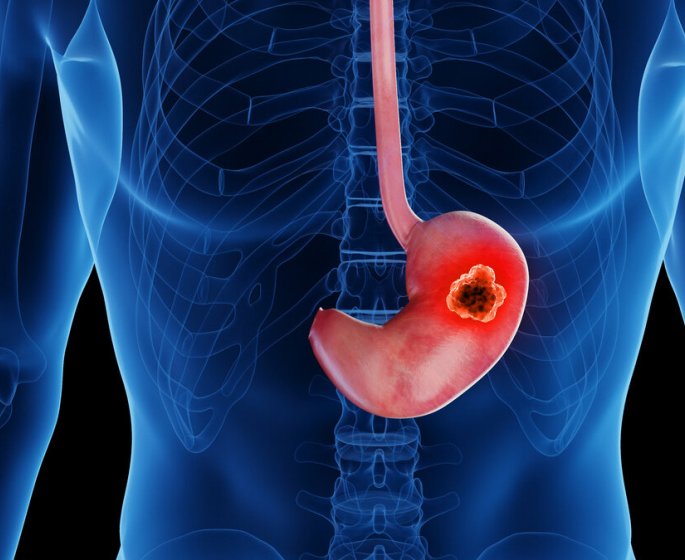 Cancer de l’estomac : un nouveau traitement decouvert