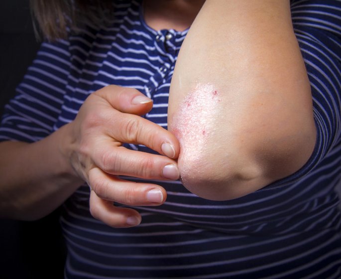 Psoriasis : la complication qui touche 1 patient sur 2