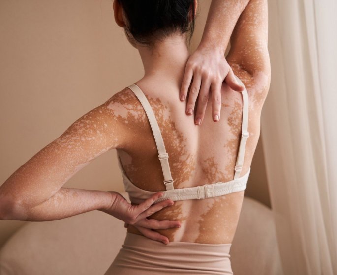 Vitiligo : dentifrice, teinture... ils peuvent augmenter le risque