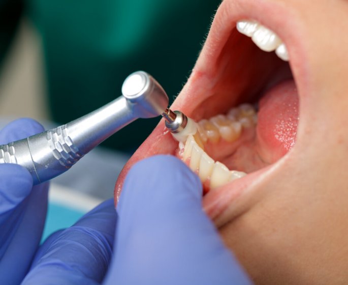 Vous voulez eviter les caries ? Bientot une nouvelle generation de dents chez le dentiste