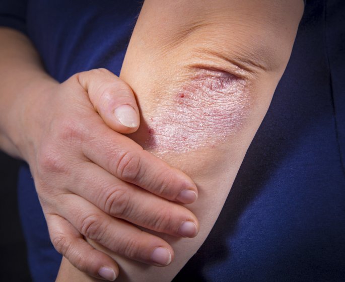 Psoriasis des coudes et genoux : quelles solutions et traitements ?