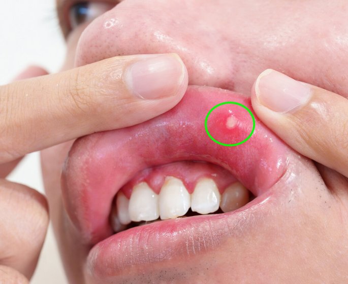 Votre dentifrice est-il coupable de vos aphtes ? L-avis de l-expert et nos solutions