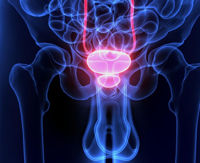 Cancer de la vessie : 3 erreurs a eviter