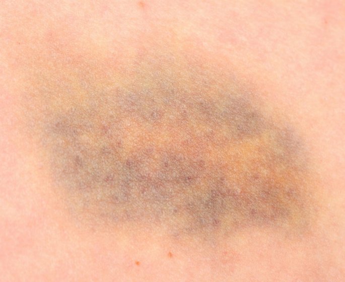 Ecchymose : pourquoi elle passe du bleu au jaune ?