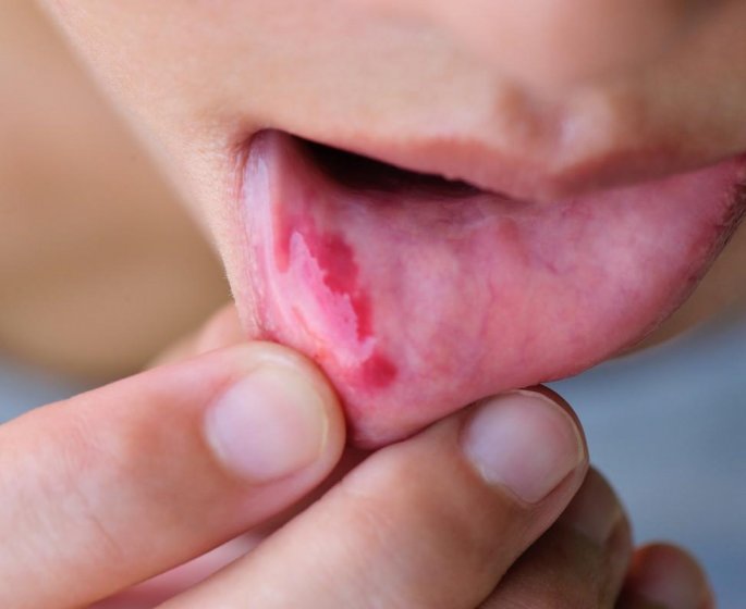 Cancer de la bouche : les non-fumeurs plus a risque ?