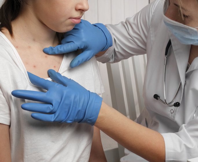 Rougeole : face a la hausse des cas, doit-on craindre une epidemie pendant les JO 2024 ?