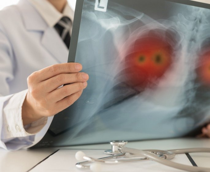 Cancer du poumon : 3 nouveaux types decouverts chez les non-fumeurs