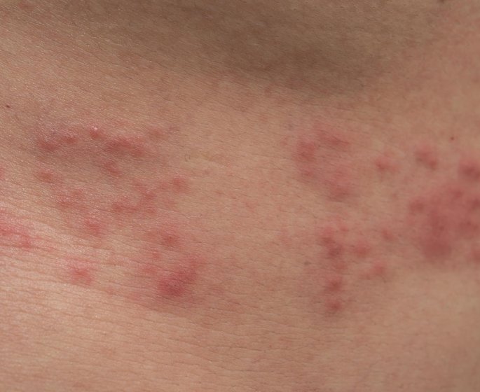 Eruption cutanee au visage : comment reconnaitre un zona ?