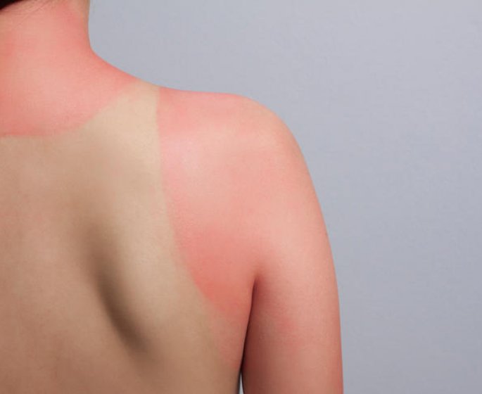 Coups de soleil : quand faut-il consulter ?
