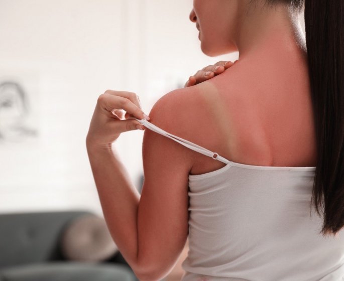Coup de soleil : ce qu-il faut manger apres