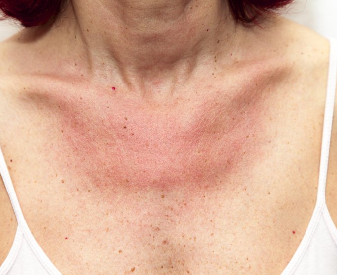 Allergie au soleil : 5 gestes pour la soulager 