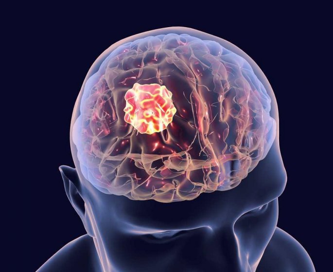 Plus votre cerveau est gros plus vous risquez d’avoir un cancer
