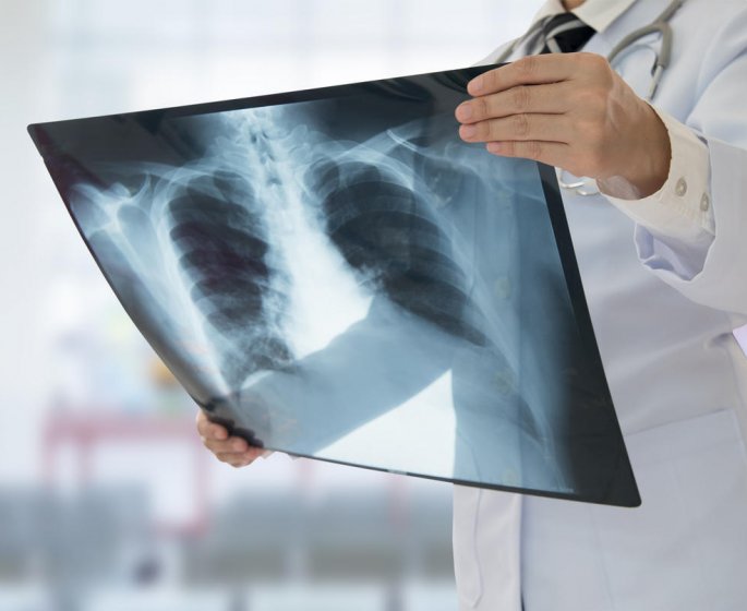 Cancer du poumon : pres de 5 ans de vie en plus grace au depistage precoce