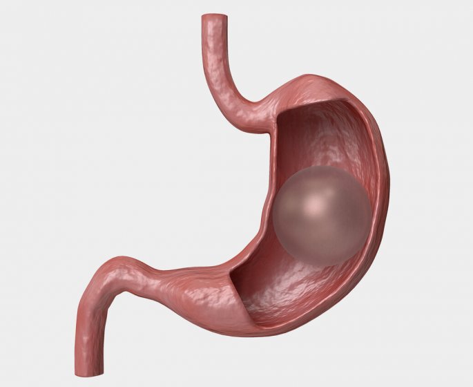 “En 4 mois, j-ai perdu 26 kilos grace a un ballon gastrique”