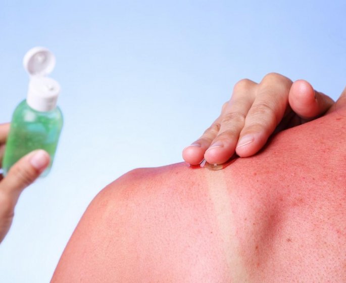 8 choses a ne pas mettre sur un coup de soleil