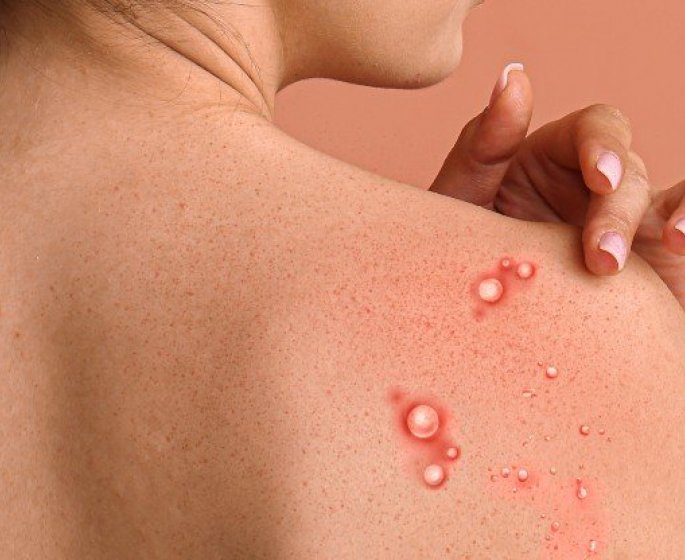 Variole du singe : 5 raisons pour lesquelles l’alerte maximale a ete instauree 