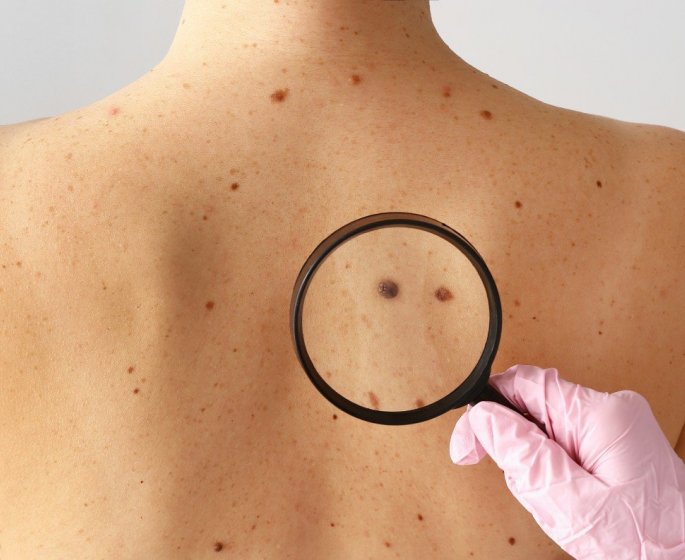 Hydrochlorothiazide : ce medicament contre l-hypertension augmente les risques de melanome
