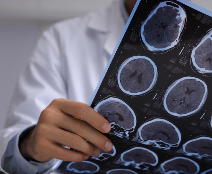 Sclerose en plaques : qui sont les personnes touchees par la maladie ?