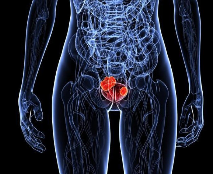 Cancer de la vessie : polype ou tumeur, une difference ?