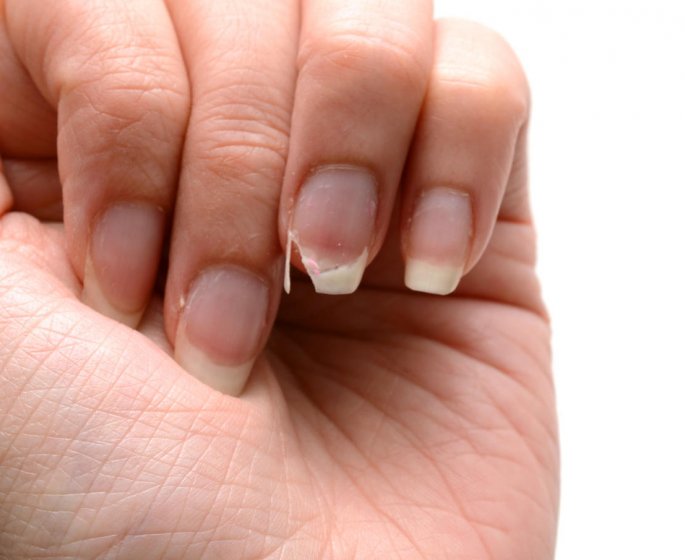 8 conseils pour rattraper des ongles abimes