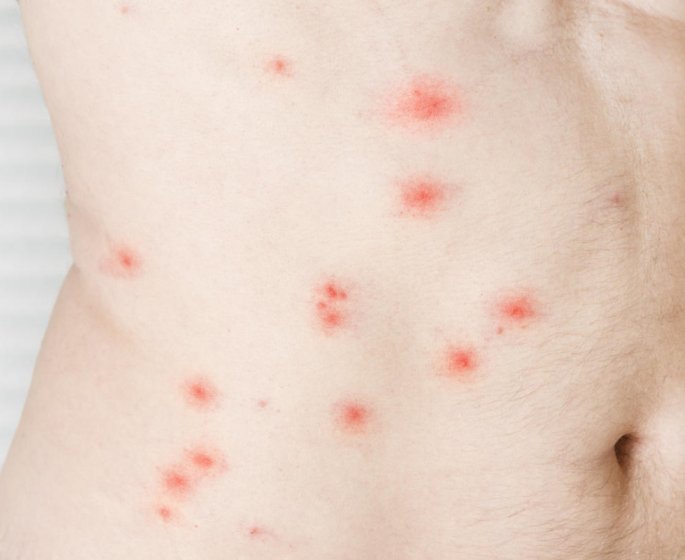 Taches rouges sur la peau : qu-est-ce que le purpura?