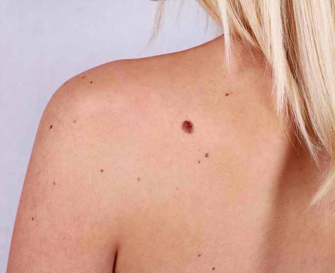 Carcinome malpighien : l-esperance de vie