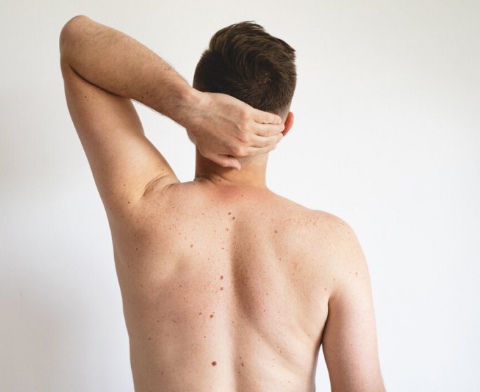 Cancer de la peau : il touche davantage les hommes et les personnes riches