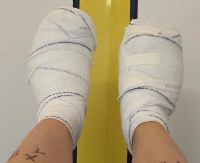 Hallux valgus : comment gerer l’apres operation ? Les conseils d’une patiente