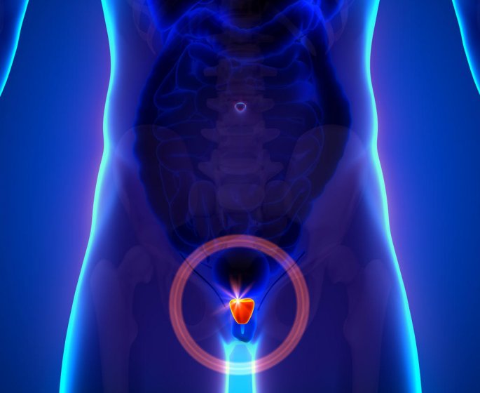 Prostatite et cancer de la prostate : la difference